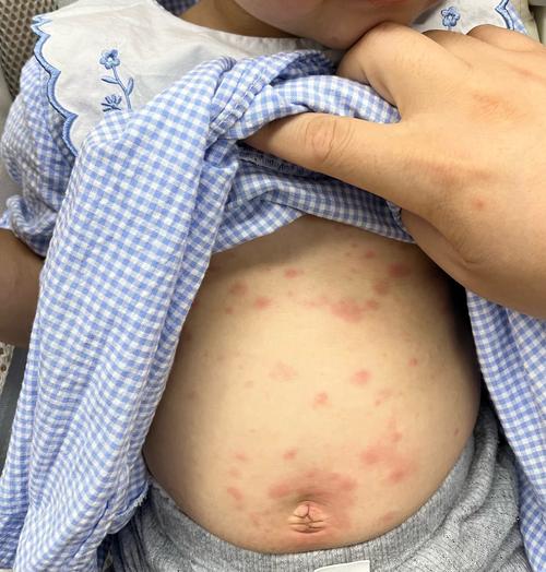 儿童身上长红疹是芥疮吗？症状和图片如何辨别？-第2张图片-郑州医学网