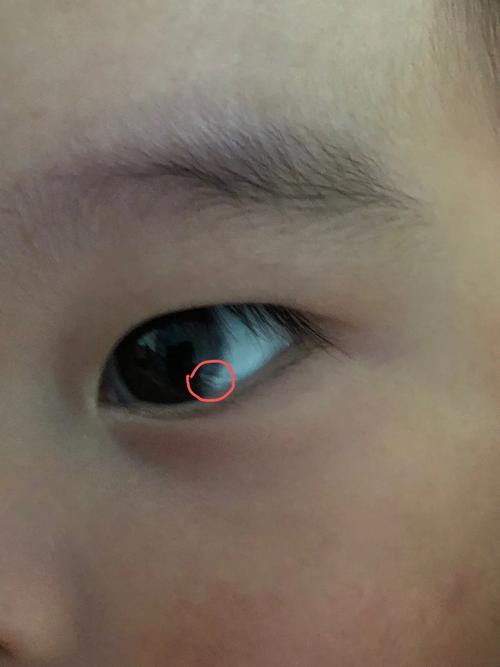 新生儿黑眼珠边缺一块-第1张图片-郑州医学网