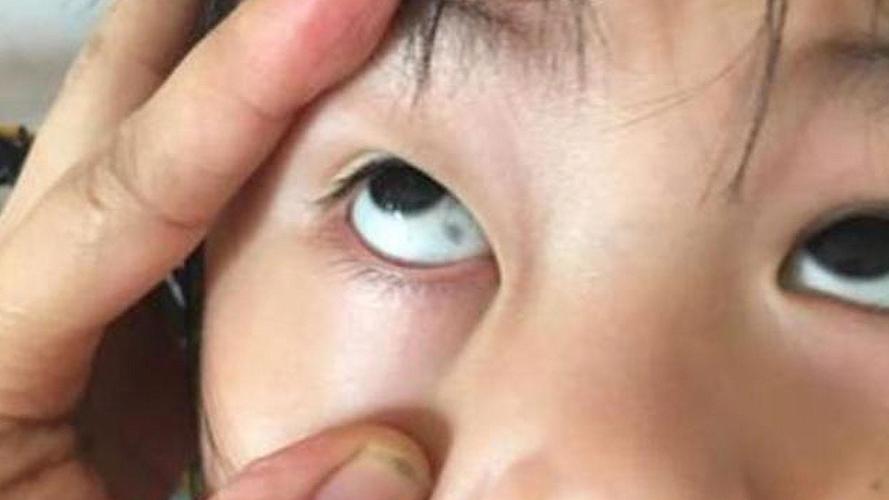 新生儿黑眼珠边缺一块-第3张图片-郑州医学网