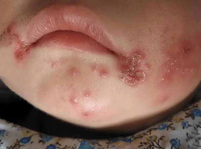 儿童疱疹病毒感染图片有哪些典型症状？如何通过图片辨别不同类型感染？-第2张图片-郑州医学网