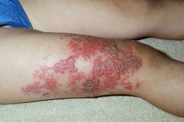 儿童疱疹病毒感染图片有哪些典型症状？如何通过图片辨别不同类型感染？-第3张图片-郑州医学网