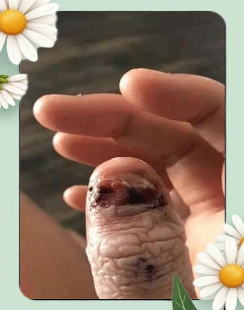 儿童咬指甲导致皮肤破损的图片是否真实存在？这些图片的拍摄与传播是否涉及隐私和伦理问题？-第2张图片-郑州医学网