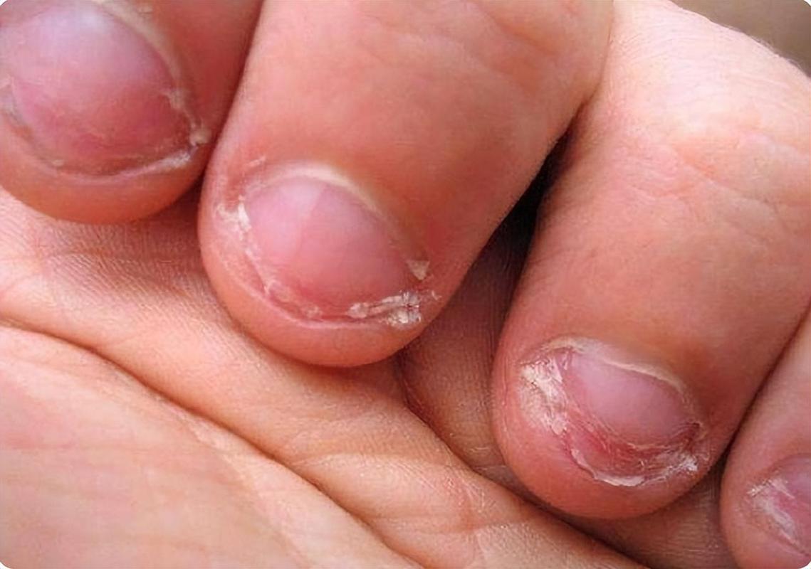 儿童咬指甲导致皮肤破损的图片是否真实存在？这些图片的拍摄与传播是否涉及隐私和伦理问题？-第3张图片-郑州医学网