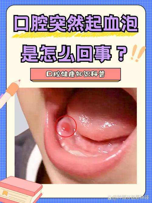 儿童上牙膛起泡怎么办-第2张图片-郑州医学网