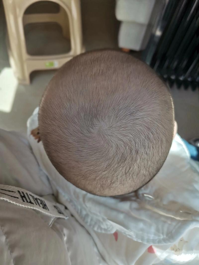 新生儿剃头发型后脑勺头发稀少怎么办？会影响头皮健康吗？-第2张图片-郑州医学网