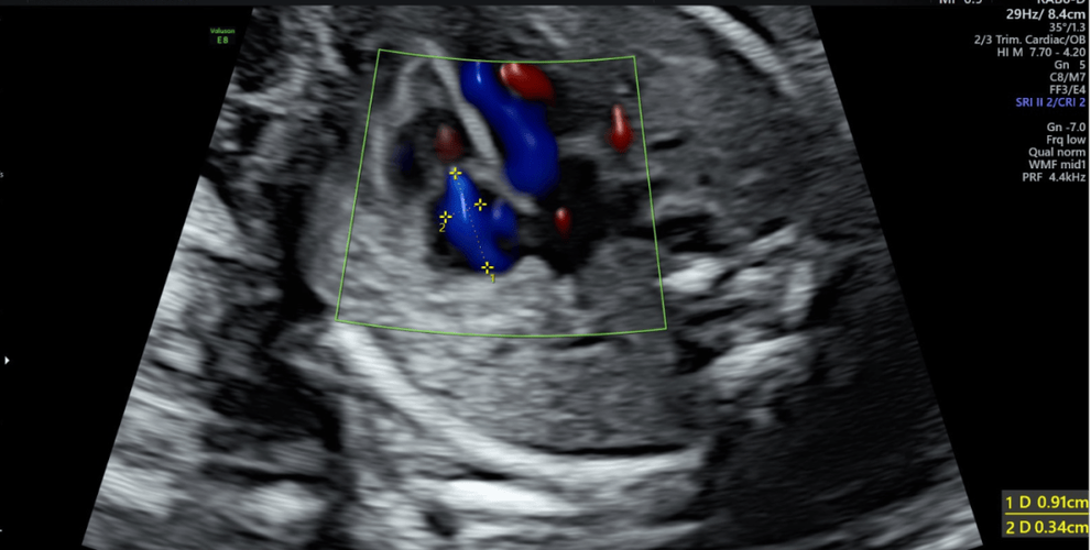 新生儿三尖瓣重度返流能自愈吗？需立即手术吗？对发育有何影响？-第2张图片-郑州医学网