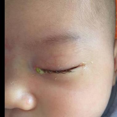 新生儿一流泪眼睛就红，是正常现象还是隐藏眼部问题？-第1张图片-郑州医学网