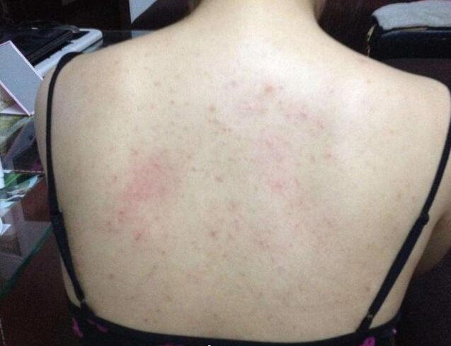 孕期背部长痘痘，该如何安全有效护理，又不会影响胎儿健康呢？-第3张图片-郑州医学网