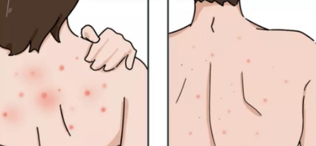 孕期背部长痘痘，该如何安全有效护理，又不会影响胎儿健康呢？-第2张图片-郑州医学网