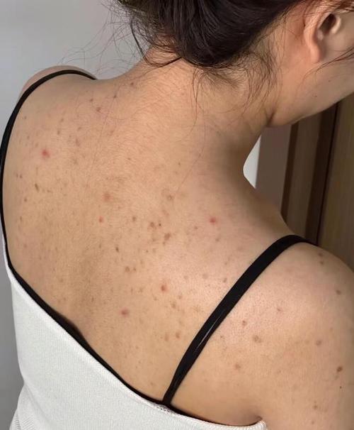 孕期背部长痘痘，该如何安全有效护理，又不会影响胎儿健康呢？-第1张图片-郑州医学网