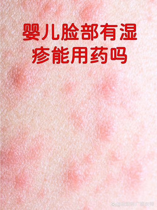 儿童脸部湿疹反复发作，到底该如何有效治疗与护理？-第3张图片-郑州医学网