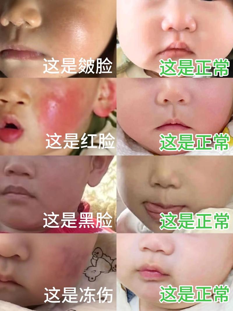 新生儿两侧脸颊不对称-第1张图片-郑州医学网