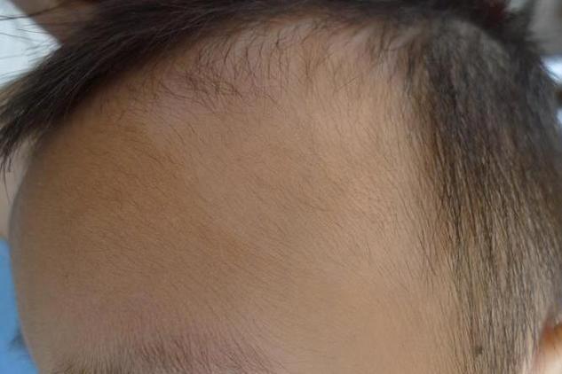 新生儿脑门上有一片白-第1张图片-郑州医学网