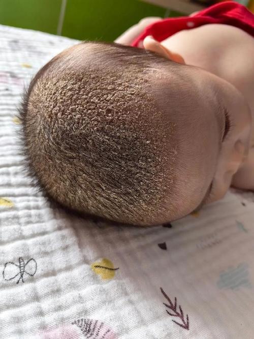 新生儿脑门上有一片白-第2张图片-郑州医学网