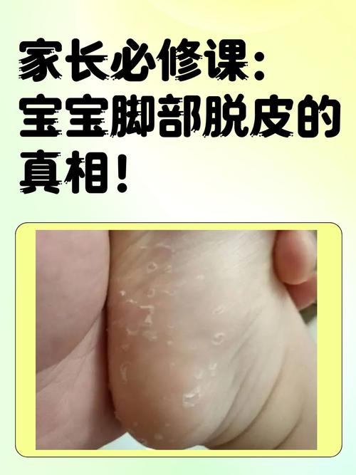 儿童得了脚气怎么治疗-第3张图片-郑州医学网