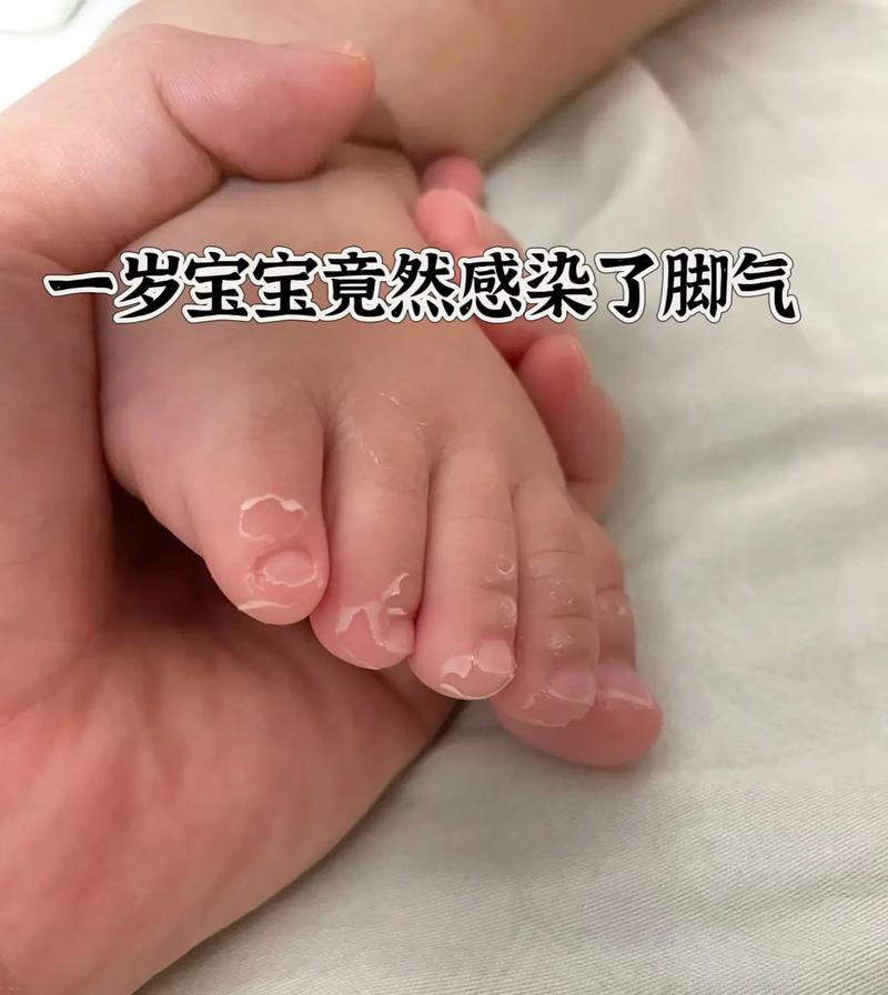 足藓会传染给新生儿吗-第2张图片-郑州医学网