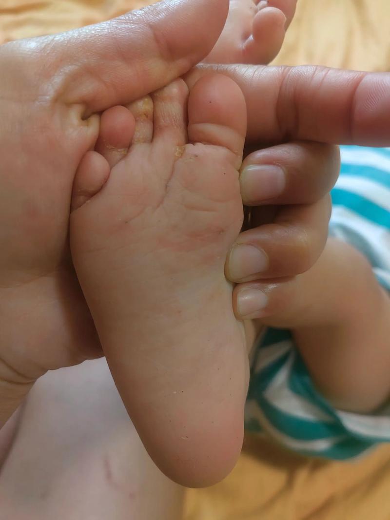 足藓会传染给新生儿吗-第3张图片-郑州医学网