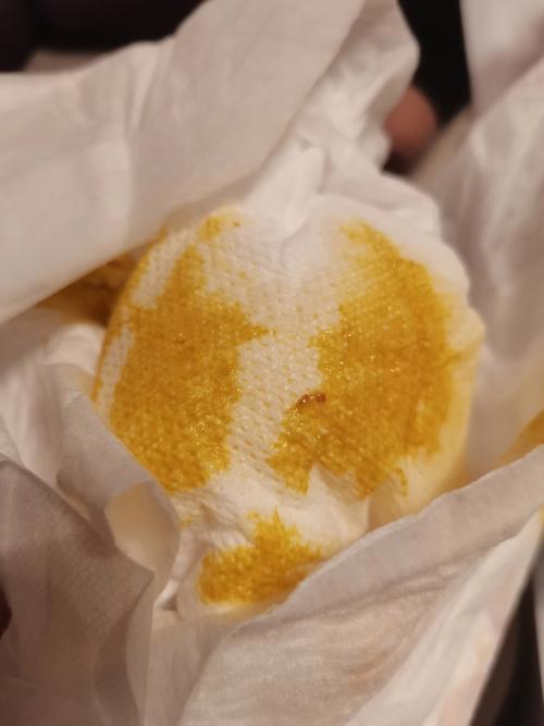 新生儿便便里有红血丝-第1张图片-郑州医学网