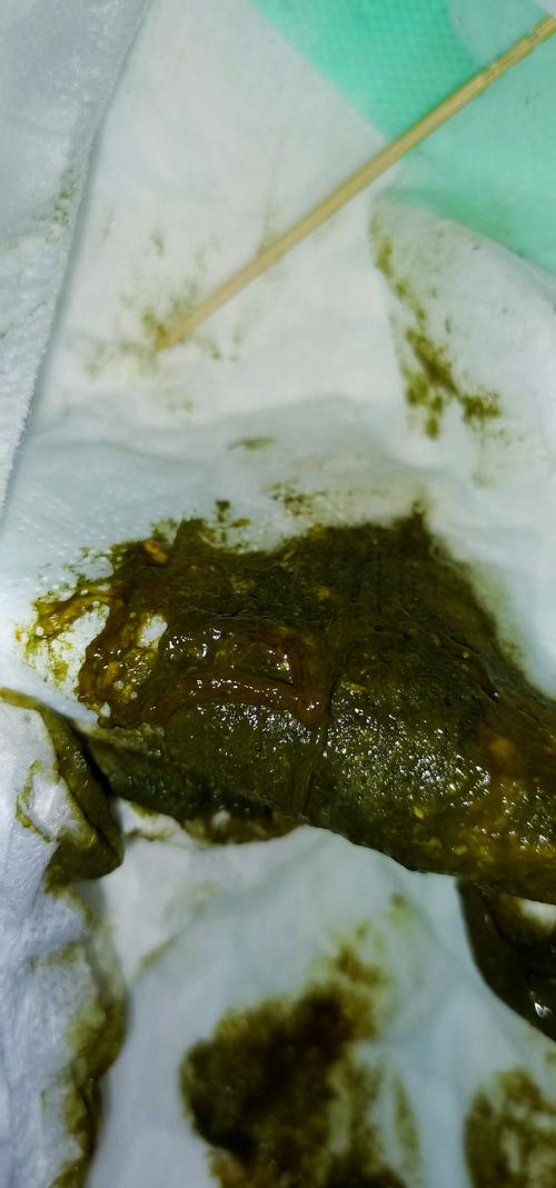 新生儿便便里有红血丝-第2张图片-郑州医学网