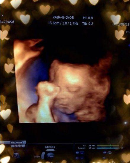 备孕期间照B超安全吗？对胎儿发育有影响吗？-第1张图片-郑州医学网