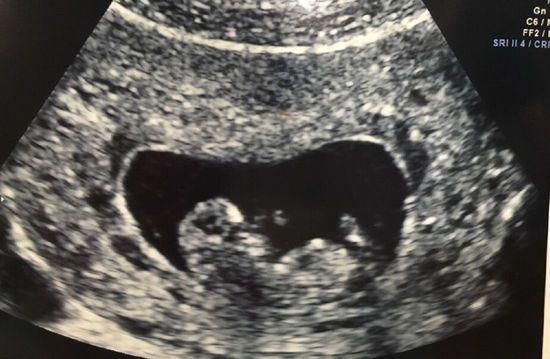 备孕期间照B超安全吗？对胎儿发育有影响吗？-第2张图片-郑州医学网