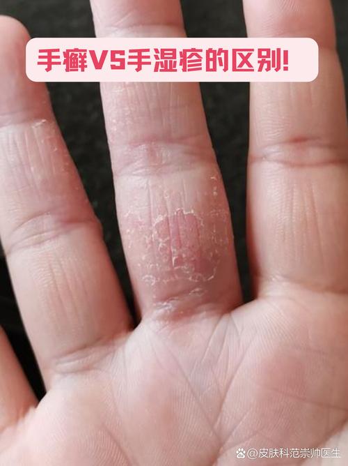 儿童手癣是怎么引起的-第1张图片-郑州医学网