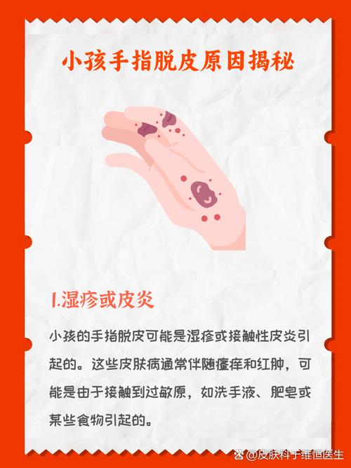 儿童手癣是怎么引起的-第3张图片-郑州医学网