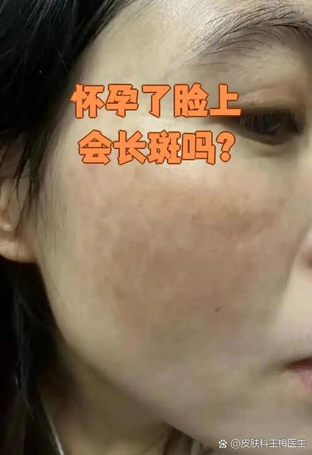 怀孕期间如何不长雀斑-第1张图片-郑州医学网