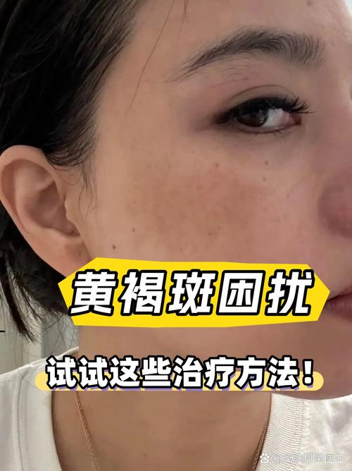 怀孕期间如何不长雀斑-第2张图片-郑州医学网