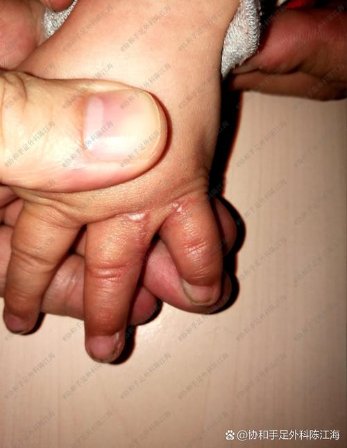 新生儿手指缝里有棉絮-第2张图片-郑州医学网