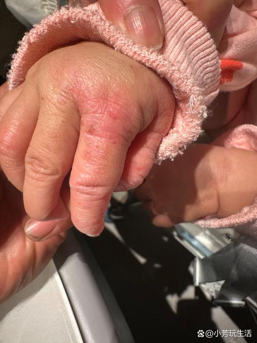 新生儿手指缝里有棉絮-第3张图片-郑州医学网