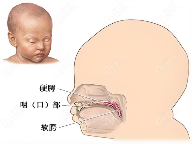 新生儿腭裂多大做手术-第1张图片-郑州医学网