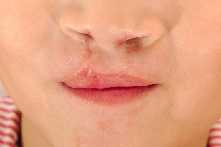 新生儿腭裂多大做手术-第3张图片-郑州医学网