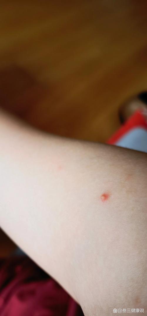 怀孕期间出现皮下小红点，是孕期正常现象还是需警惕的健康信号？-第2张图片-郑州医学网