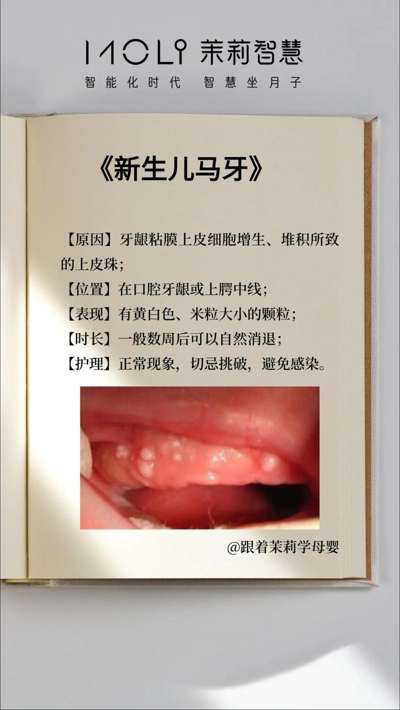 新生儿起马牙子怎么办-第2张图片-郑州医学网