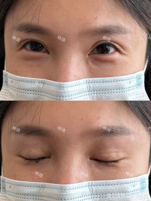 备孕期间能做双眼皮吗？手术风险是否会影响胎儿健康？-第3张图片-郑州医学网