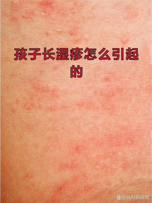儿童湿疹流水怎么回事-第2张图片-郑州医学网