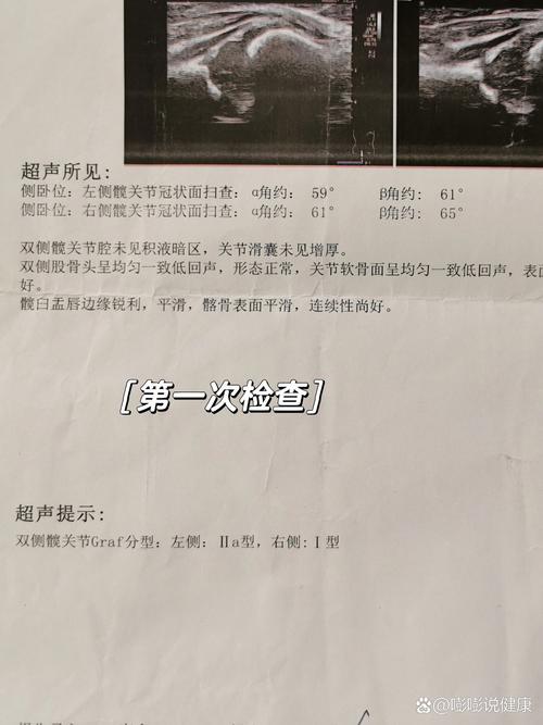 新生儿髋关节彩超筛查怎么做？关键指标有哪些？异常情况如何干预？-第3张图片-郑州医学网