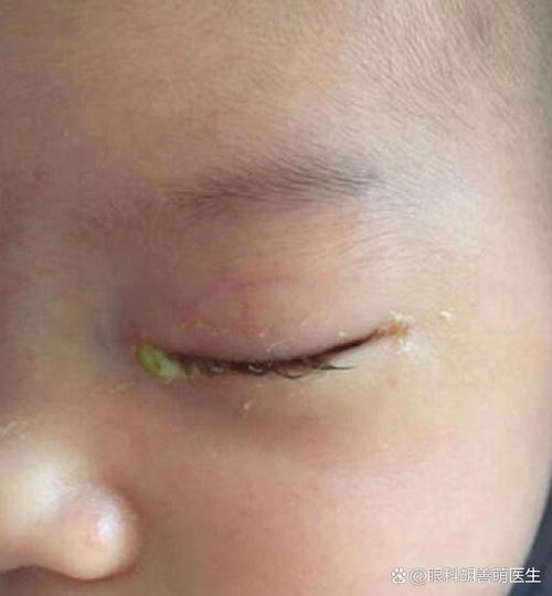 新生儿泪囊炎会复发吗-第2张图片-郑州医学网
