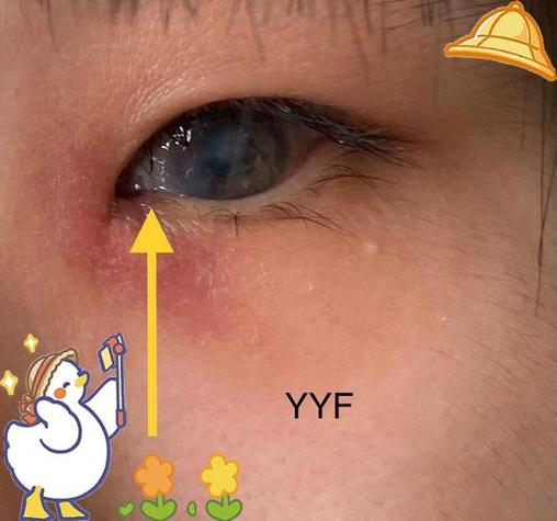 新生儿泪囊炎会复发吗-第3张图片-郑州医学网