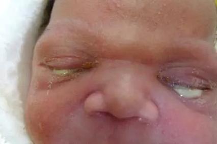 新生儿眼角红有分泌物-第1张图片-郑州医学网