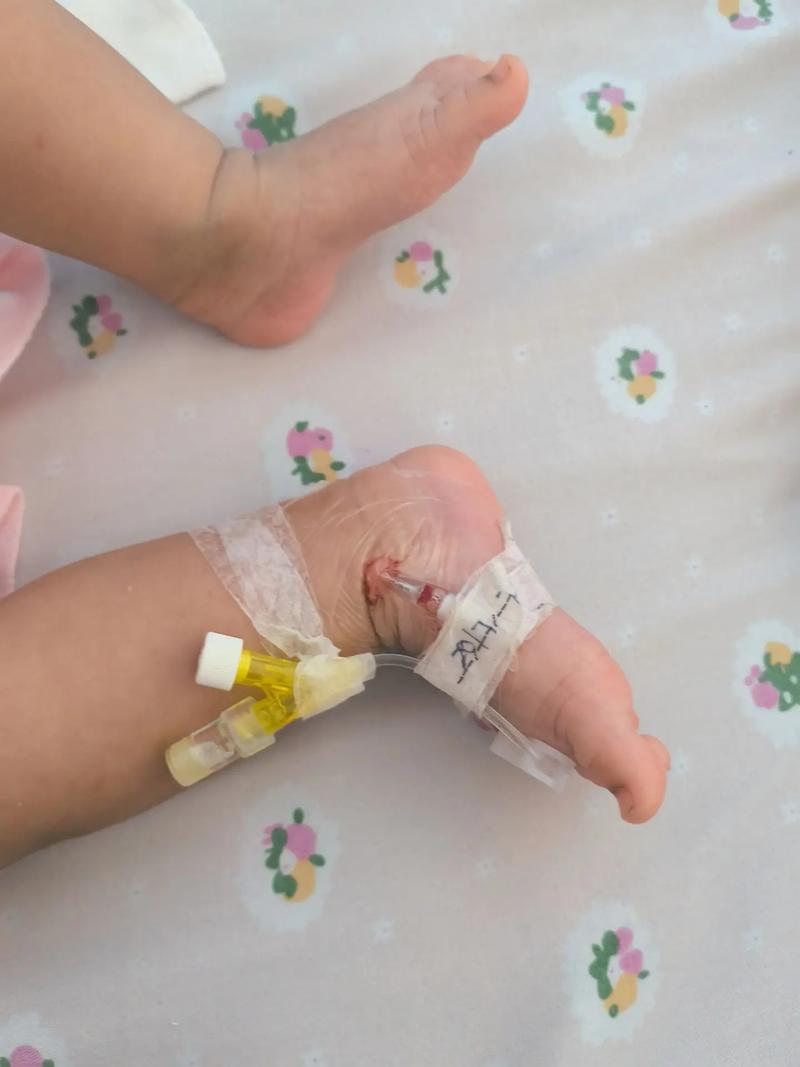 新生儿呛奶后咳嗽有痰-第2张图片-郑州医学网