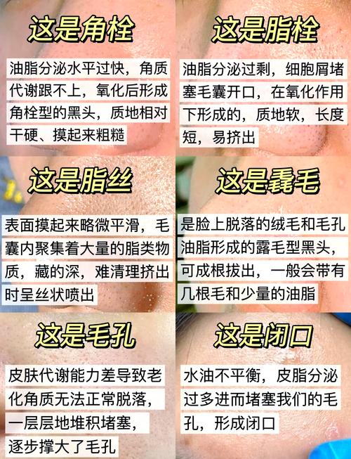 怀孕期间祛黑头有风险吗?哪些方法既安全又有效?-第1张图片-郑州医学网 怀孕期间祛黑头有风险吗?哪些方法既安全又有效?-第1张图片-郑州医学网