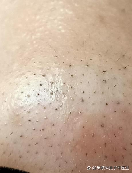 怀孕期间祛黑头有风险吗？哪些方法既安全又有效？-第3张图片-郑州医学网