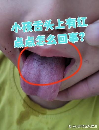 儿童舌头上有很多红点-第1张图片-郑州医学网