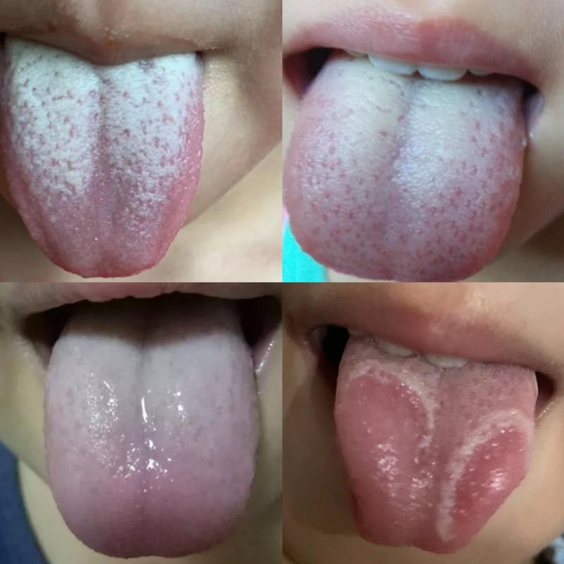 儿童舌头上有很多红点-第3张图片-郑州医学网