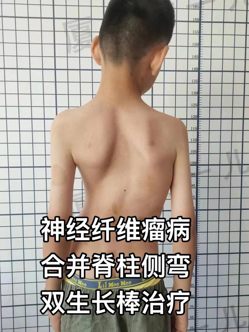 儿童神经母细胞瘤症状-第3张图片-郑州医学网