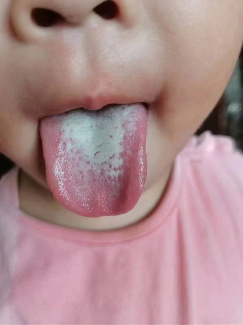 刚出生新生儿舌头发紫是正常现象还是缺氧信号?需要立即就医吗?-第2张图片-郑州医学网 刚出生新生儿舌头发紫是正常现象还是缺氧信号?需要立即就医吗?-第2张图片-郑州医学网