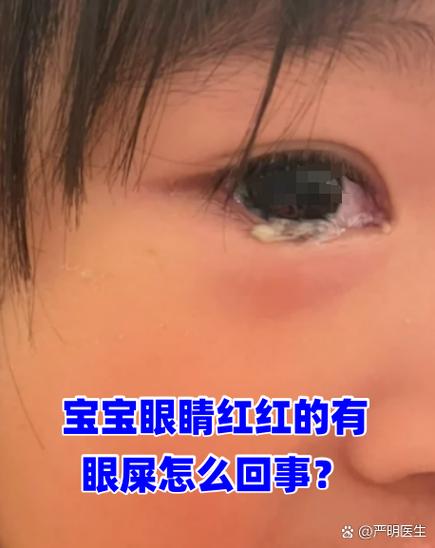 儿童眼睛红有眼屎是结膜炎吗？这些图片能帮你判断吗？-第1张图片-郑州医学网