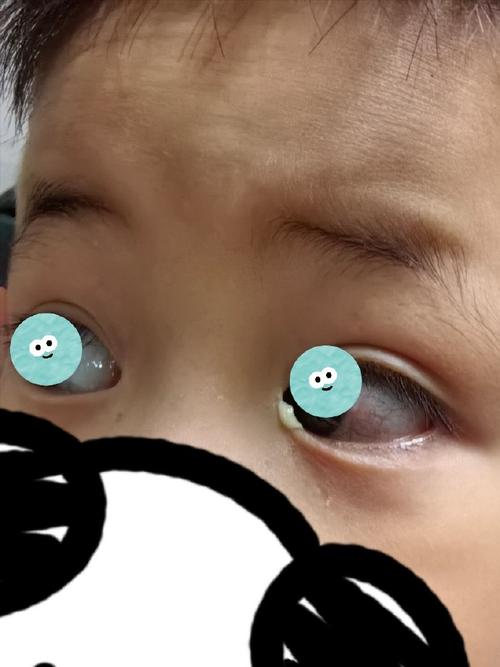 儿童眼睛红有眼屎是结膜炎吗？这些图片能帮你判断吗？-第3张图片-郑州医学网